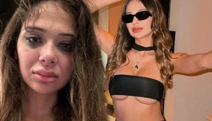 Merve Taşkın, sevgilisi tarafından şiddete maruz kaldı!  Bu fenomenin kol ve bacaklarındaki yaralanmalar olağan bir durum... "Tehlikeli yerlerime çok vurdu."