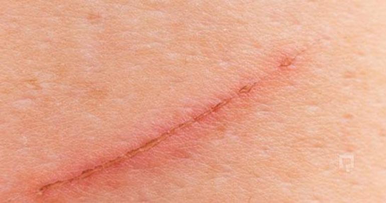 Tırnak izleri nasıl kaldırılır? Yüzünüzde ve cildinizdeki tırnak izleri nasıl giderilir?